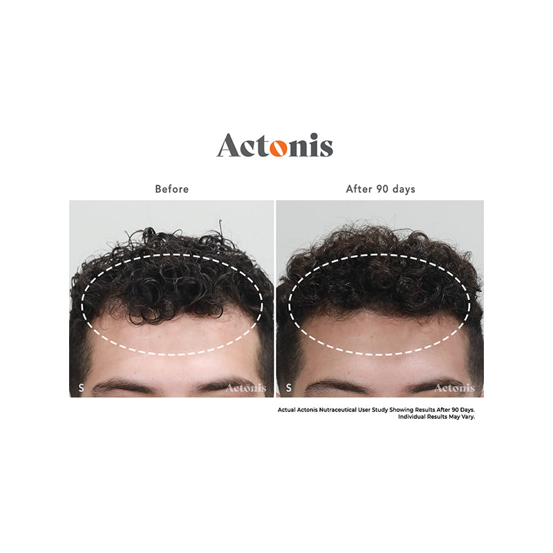 Actonis™ Hair & Scalp Dual Action Supplements