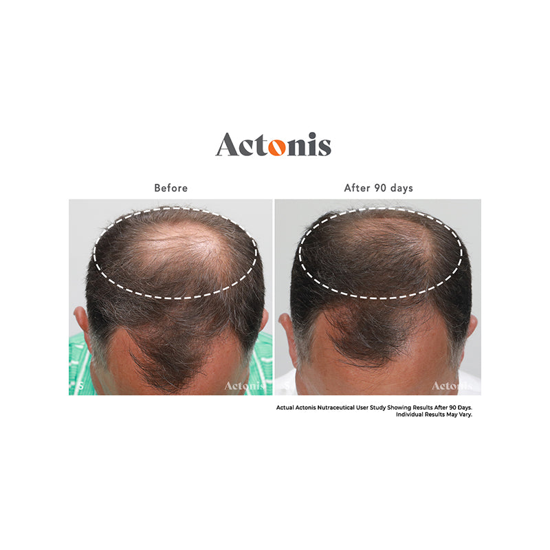 Actonis™ Hair & Scalp Dual Action Supplements