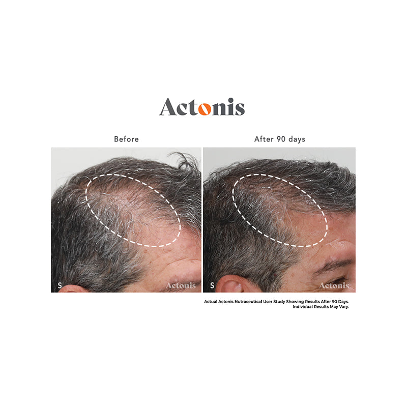 Actonis™ Hair & Scalp Dual Action Supplements