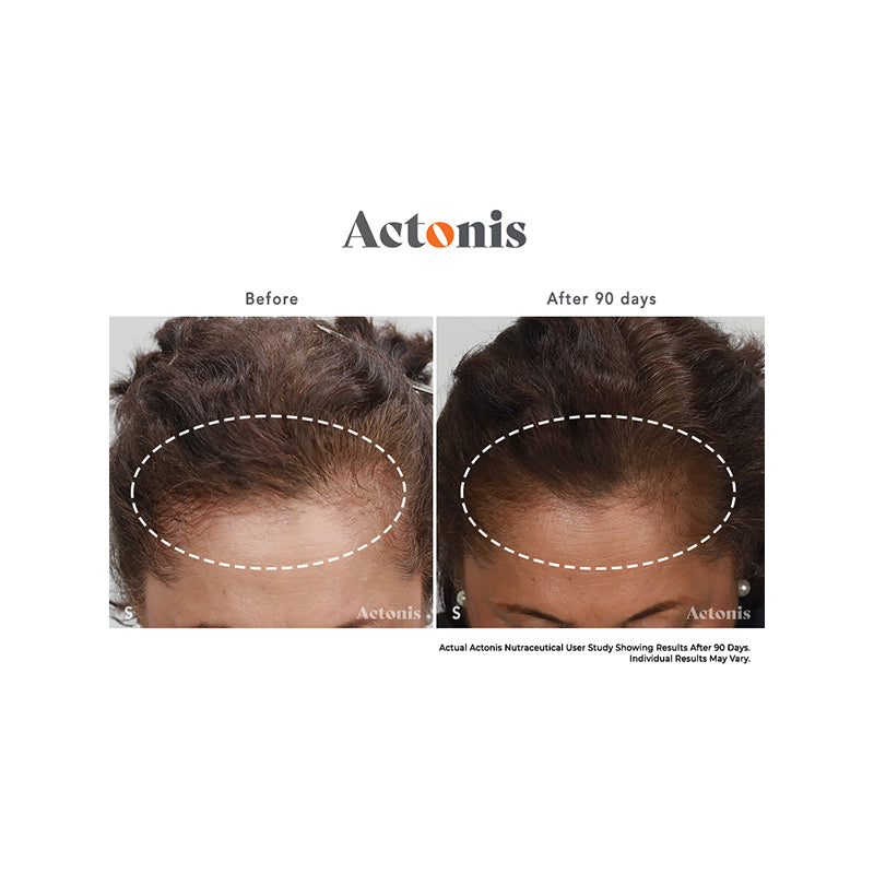 Actonis™ Hair & Scalp Dual Action Supplements