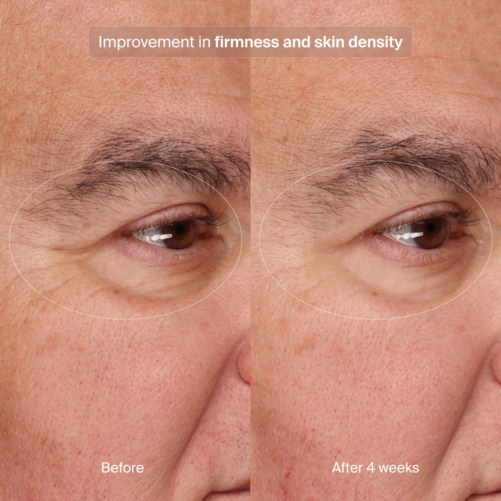 Pavise® Precision Eye Lift