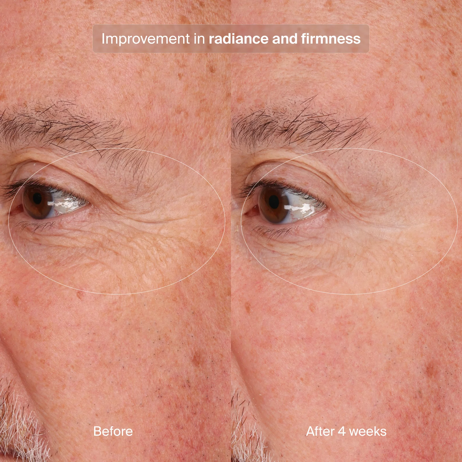 Pavise® Precision Eye Lift