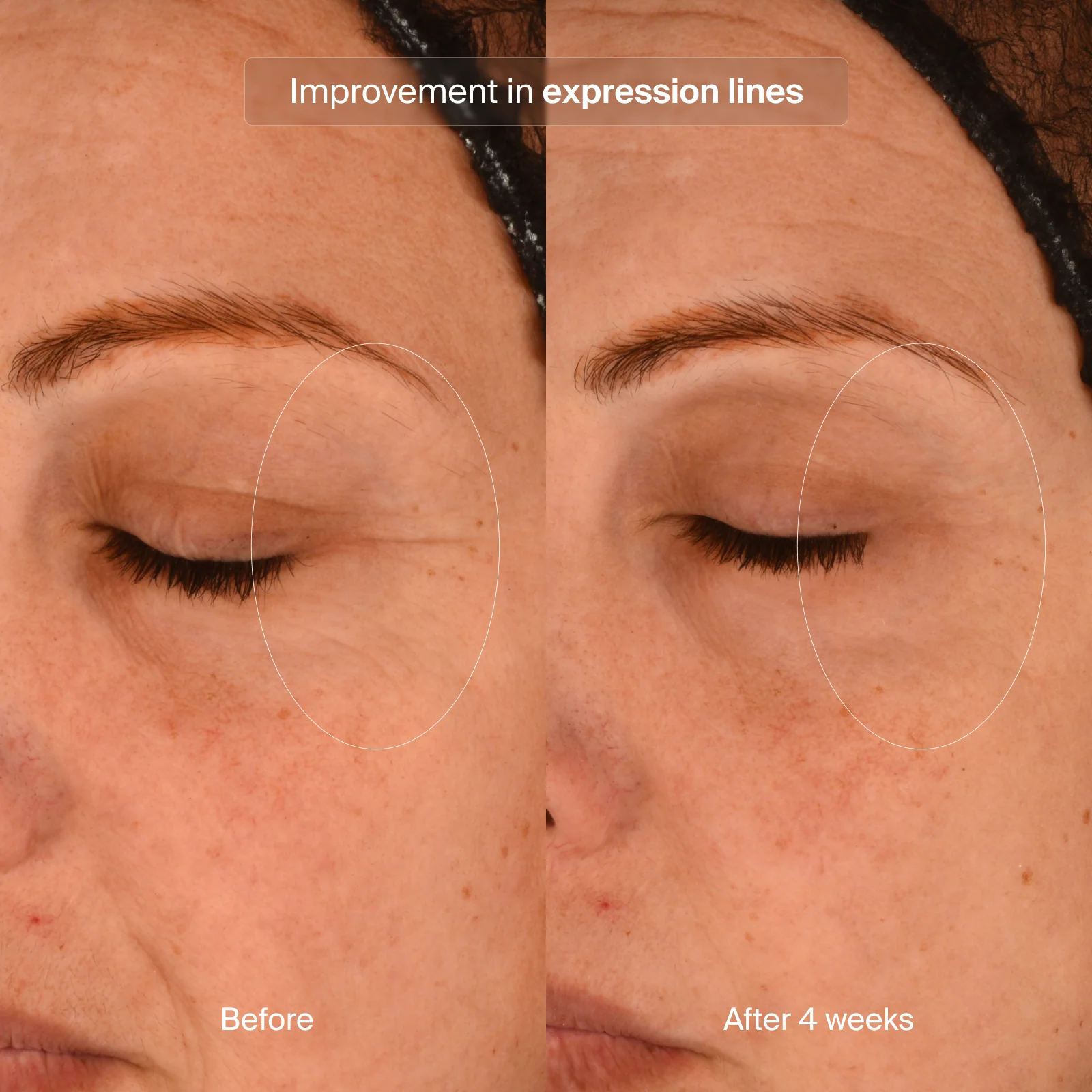 Pavise® Precision Eye Lift