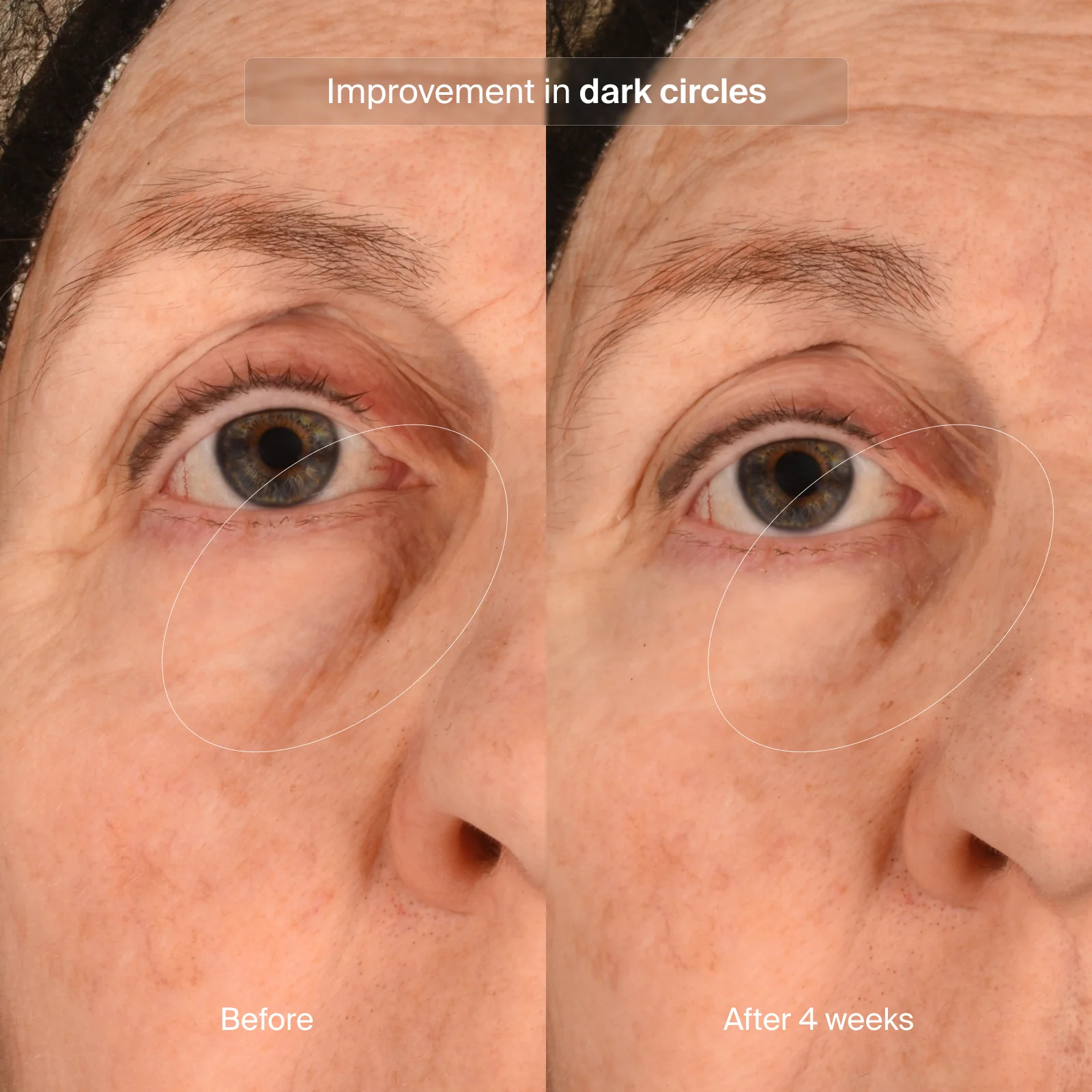Pavise® Precision Eye Lift