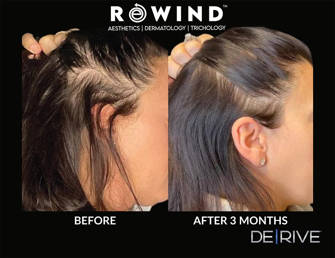 DE|RIVE - Hair Restoration System