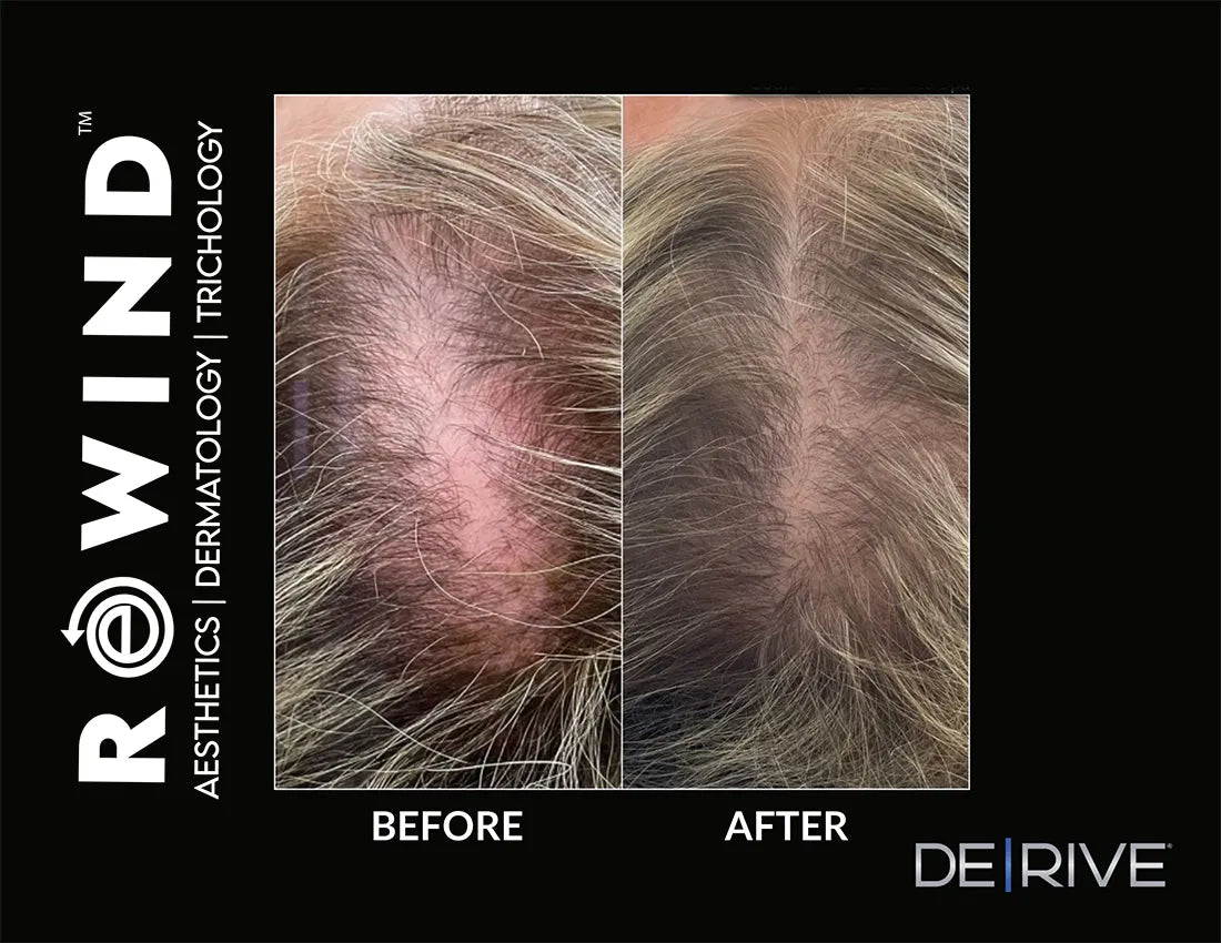 DE|RIVE - Hair Restoration System