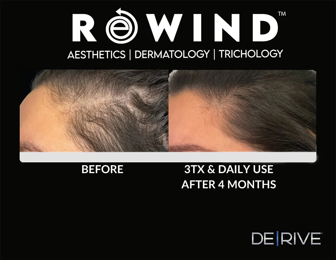 DE|RIVE - Hair Restoration System