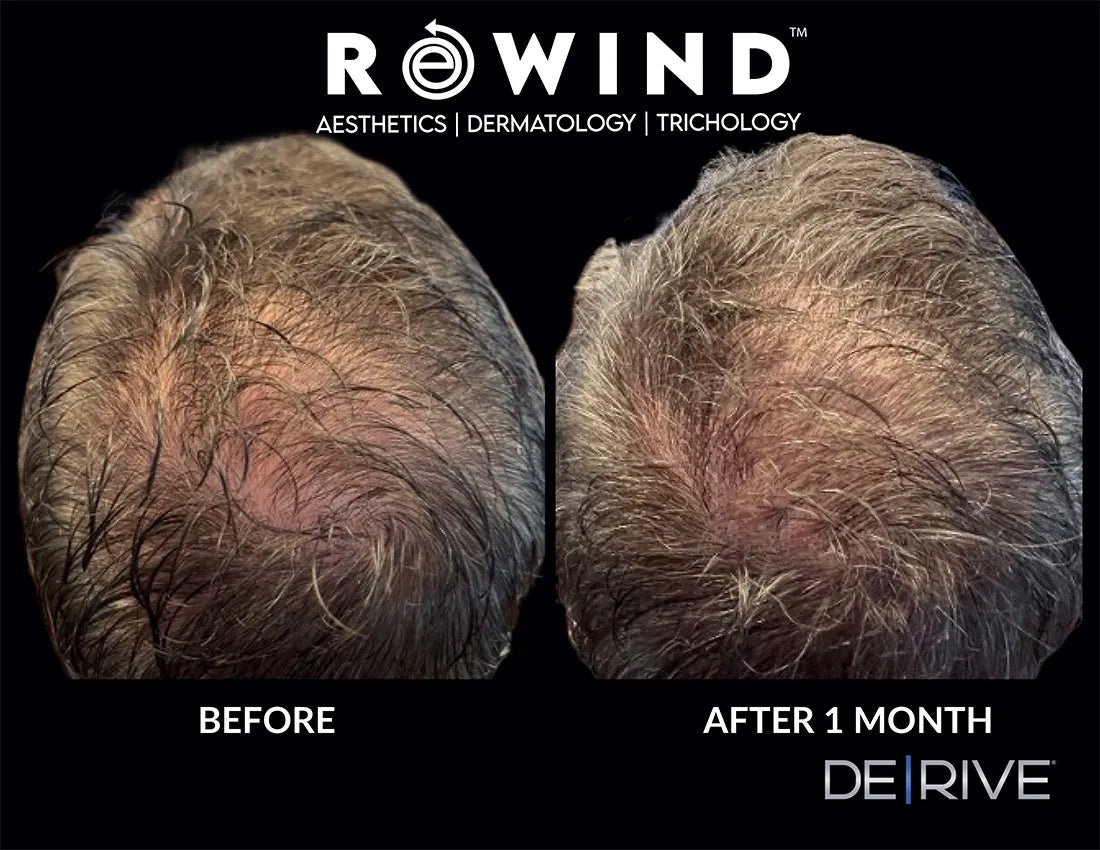 DE|RIVE - Hair Restoration System