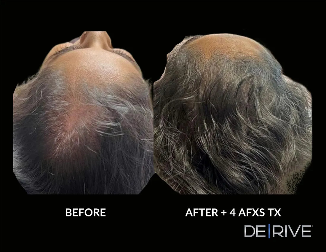 DE|RIVE - Hair Restoration System