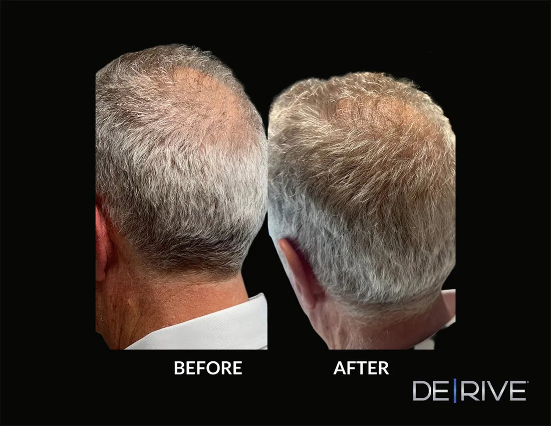 DE|RIVE - Hair Restoration System