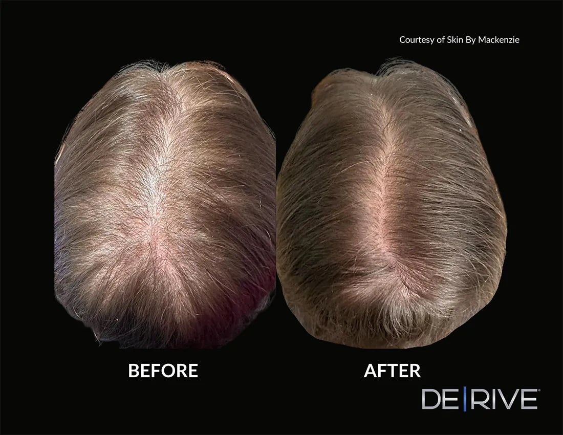 DE|RIVE - Hair Restoration System
