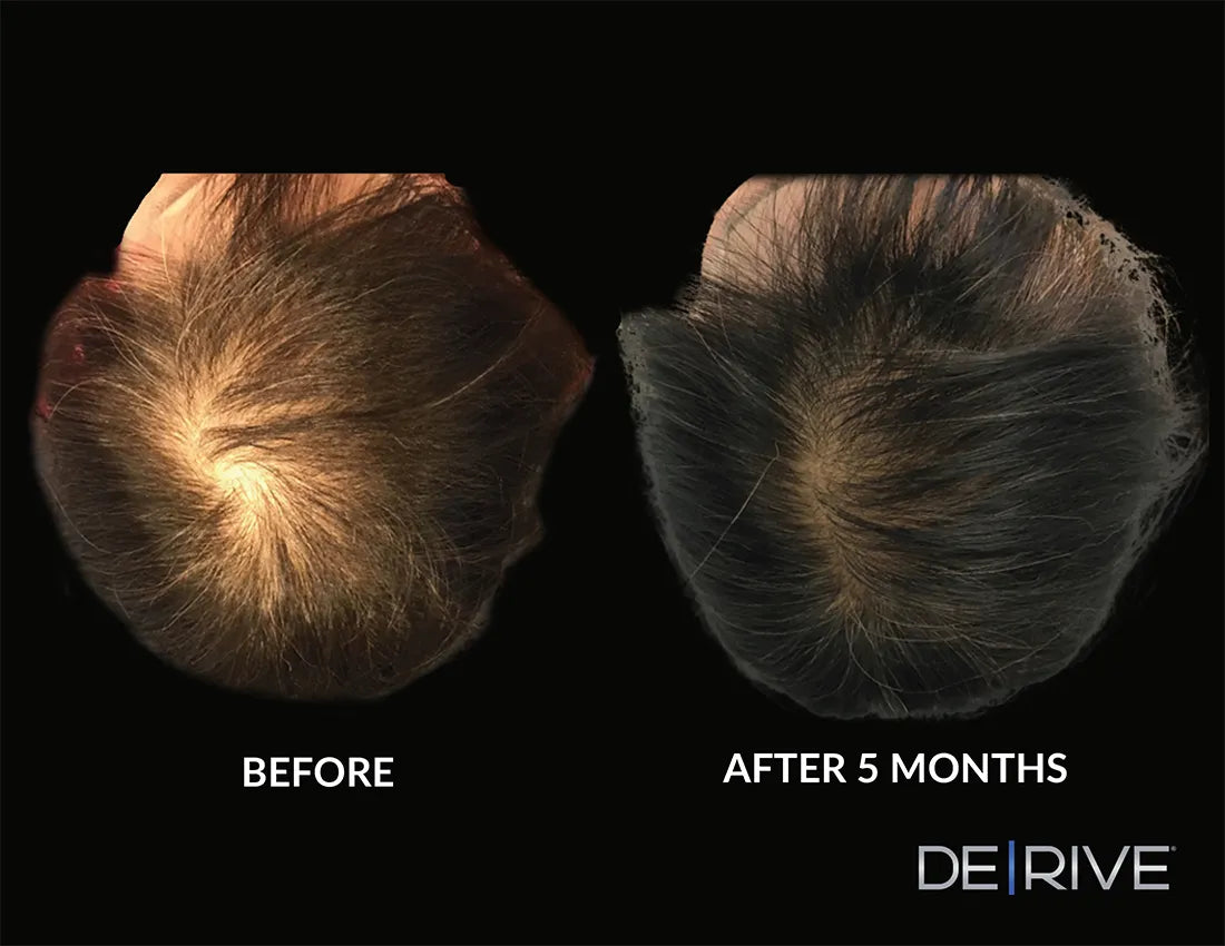 DE|RIVE - Hair Restoration System