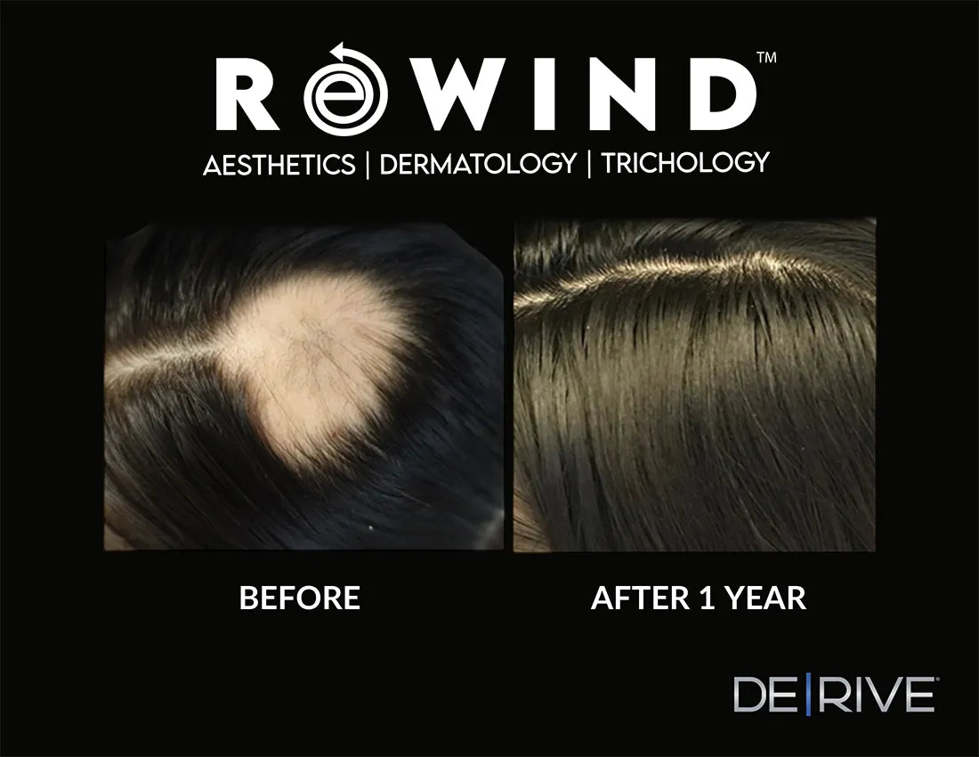 DE|RIVE - Hair Restoration System
